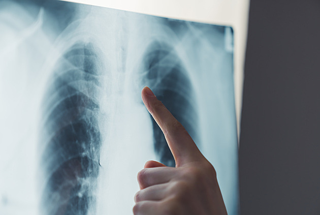 Nemoc, která se nevyhnula ani princezně. Čeští lékaři se na plicní fibrózu více zaměří