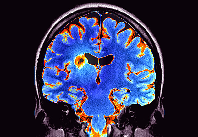 Myslela jsem, že jsem vyčerpaná. Ve skutečnosti šlo o roztroušenou sklerózu